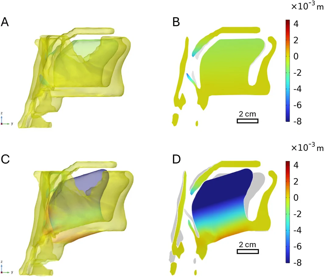 Airway deformation in three-dimensional and sagittal views under negative pressure